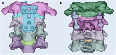 The retropharyngeal reduction plate for atlantoaxial dislocation: a finite element analysis